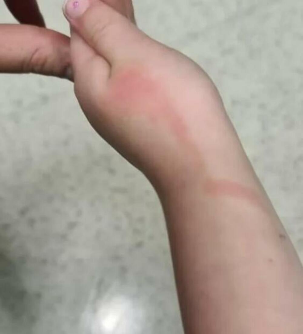 Crvene linije na koži, Koža, Ruke