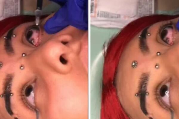 ODLUČILA DA URADI JOŠ JEDNU TETOVAŽU, PA ISTETOVIRALA BEONJAČE: Izgleda i više nego BOLNO (UZNEMIRUJUĆ SNIMAK)