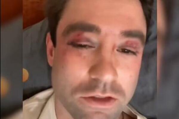 TINEJDŽERI ISPREBIJALI POZNATOG METEOROLOGA: Unakazili mu lice posekotinama i modricama! (FOTO)