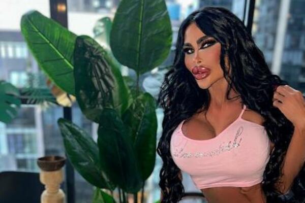 TARA DALA BOGATSTVO NA OPERACIJE, I NE STAJE: Medicinska sestra dala OZBILJNE PARE da ovako IZGLEDA (FOTO)