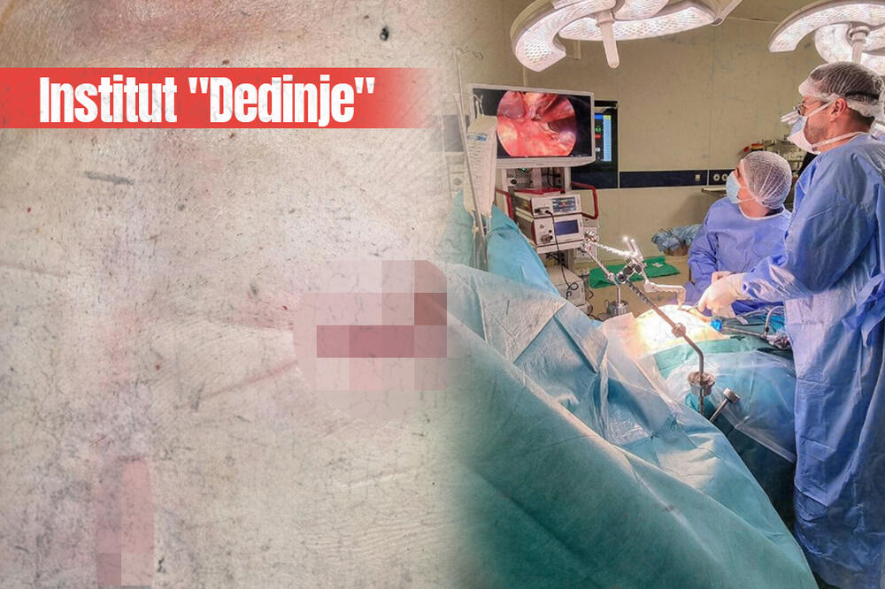 SRPSKI LEKARI PRVI NA SVETU: Na Dedinju izveden ZAHVAT na KUCAJUĆEM SRCU (FOTO)