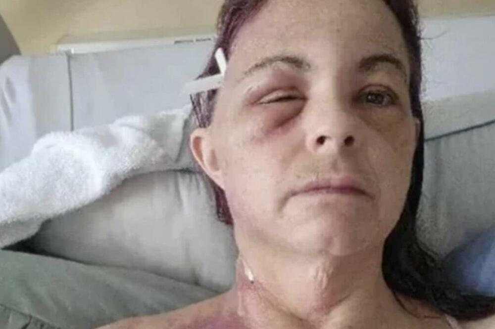 ZABOLEO JE ZUB, A ONDA JE LICE BUKVALNO KRENULO DA JOJ TRULI: Nije mogla ni da sluti šta se dešava (FOTO)