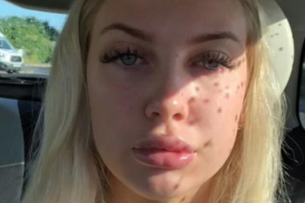 HTELA DA DOBIJE NA VOLUMENU USANA,PA PROŠLA KROZ PAKAO: Desilo joj se nešto JEZIVO, sve je ISPRIČALA! (VIDEO)