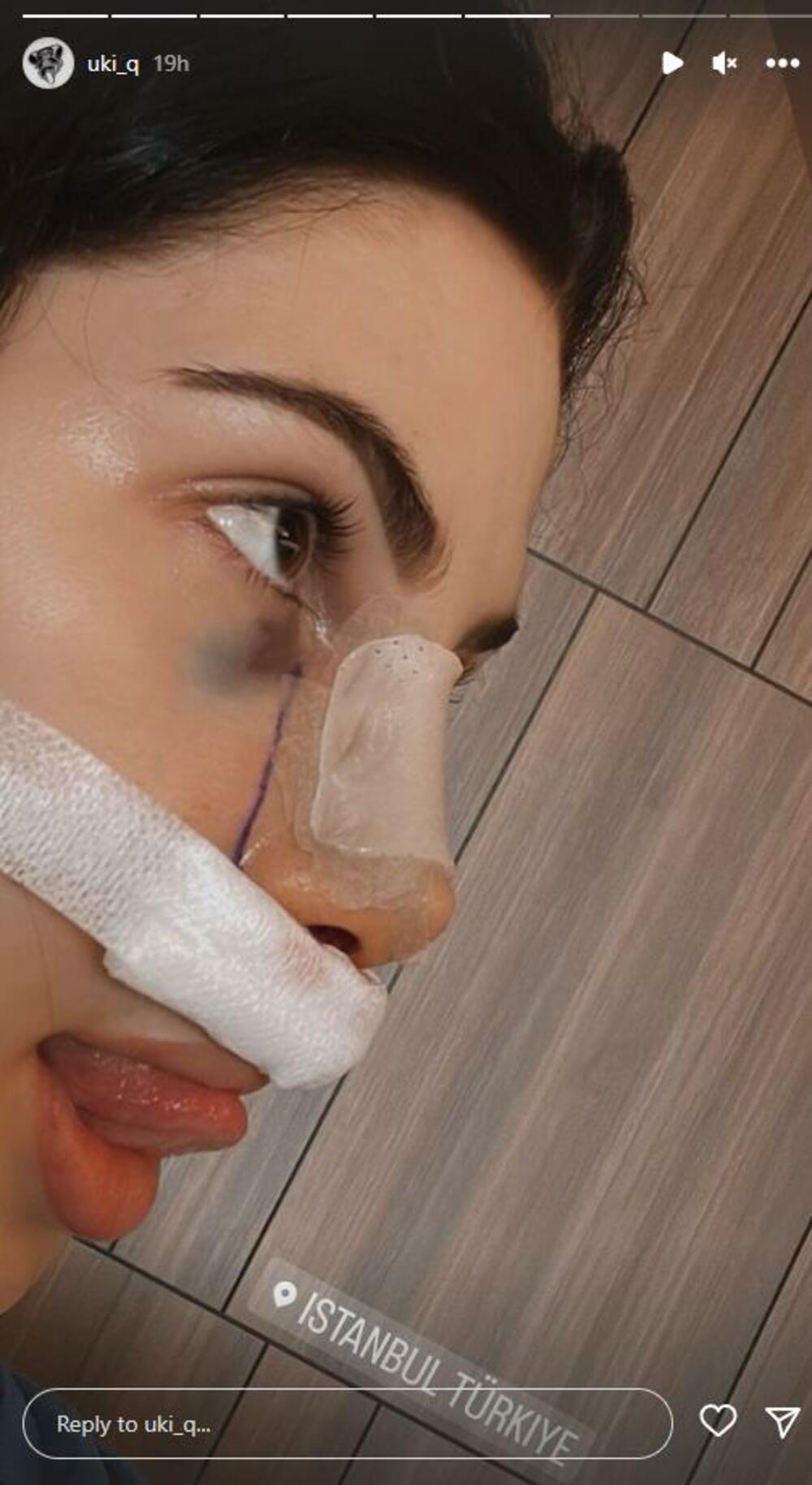 Uki Q nakon operacije nosa u Turskoj