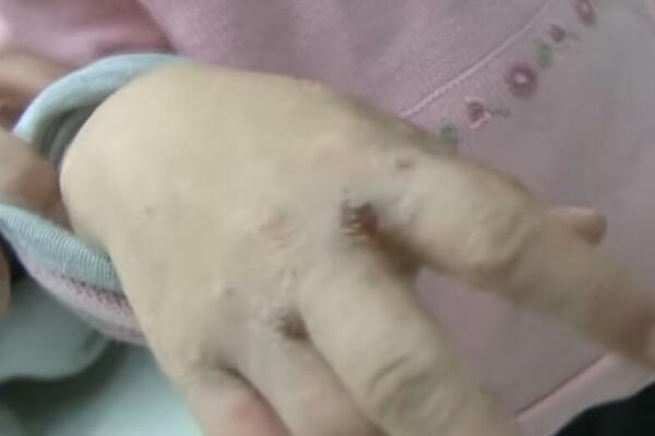 OVAJ PARAZIT IZAZIVA BOLEST ŠUGE: Skriva se u VAŠOJ ODEĆI, a godišnje zarazi 300 MILIONA LJUDI (FOTO)