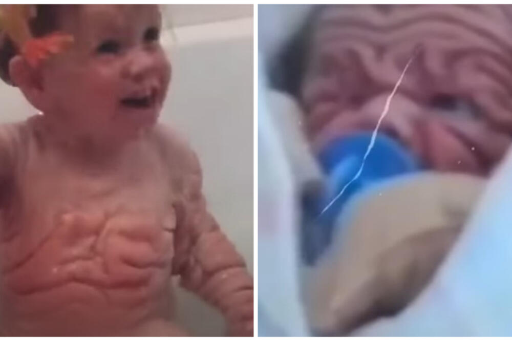 ROĐEN SA KOŽOM PETOGODIŠNJAKA, DOKTORI U ŠOKU: Prvi put VIDELI nešto TAKVO, evo kako DANAS izgleda (FOTO) (VIDEO)