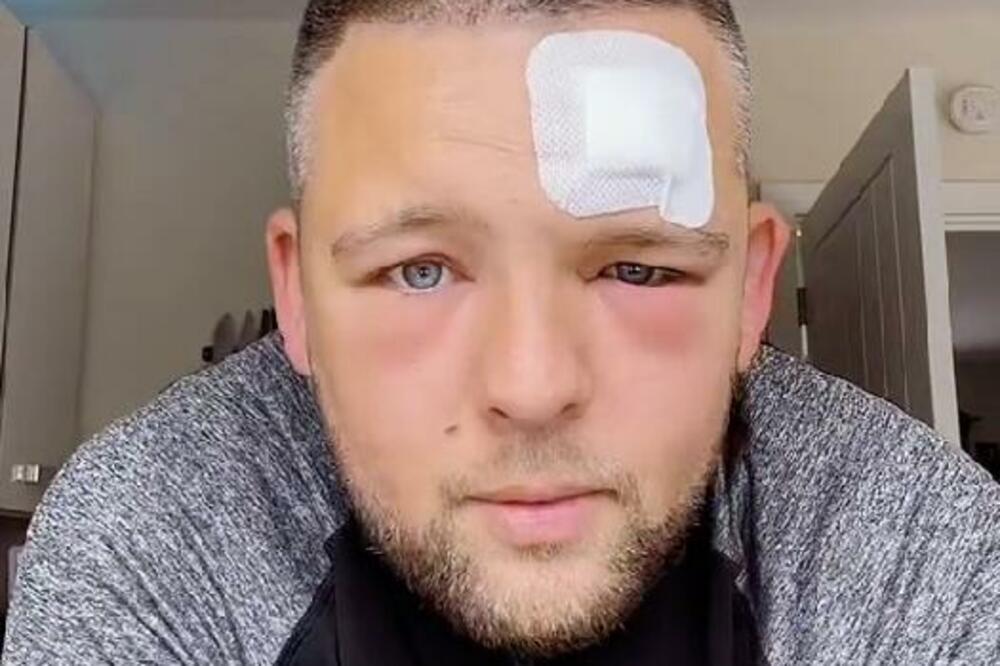 MISLIO DA IMA ČIR, OTIŠAO U BOLNICU KAD MU SE OBA OKA ZATVORILA: Umalo ga STREFIO ŠOK kad je saznao ŠTA JE (VIDEO)