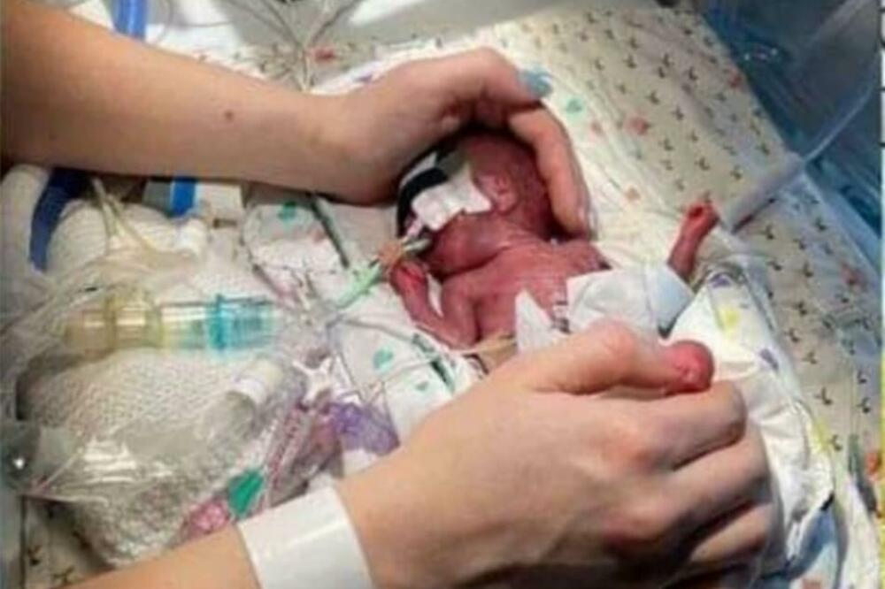 OVA BEBA JE ROĐENA SA 535 GRAMA: Lekari joj dali SAMO 10 posto šanse da preživi, a pogledajte je DANAS (FOTO)