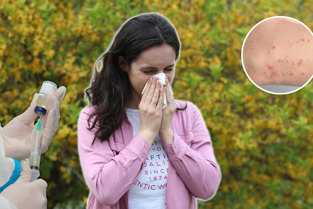 ALERGIJA NA HLADNOĆU NIJE MIT, MOŽE BITI BAŠ OPASNO! Dođe i do anafilaktičkog šoka - doktorka UPOZORILA SRBE NA OVO