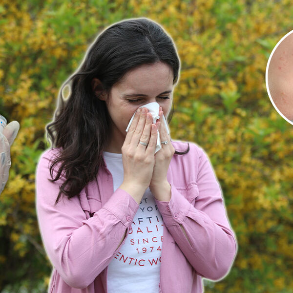 ALERGIJA NA HLADNOĆU NIJE MIT, MOŽE BITI BAŠ OPASNO! Dođe i do anafilaktičkog šoka - doktorka UPOZORILA SRBE NA OVO