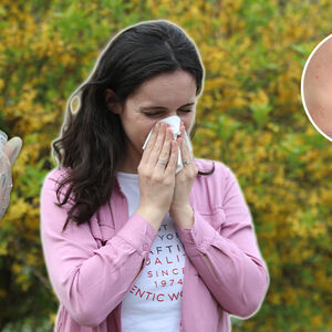 ALERGIJA NA HLADNOĆU NIJE MIT, MOŽE BITI BAŠ OPASNO! Dođe i do anafilaktičkog šoka - doktorka UPOZORILA SRBE NA OVO