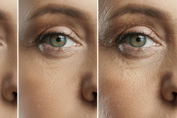 ŽELITE DA UKLONITE BORE? Bez operacije uz pomoć alpske ruže izgledajte mlađe i svežije!