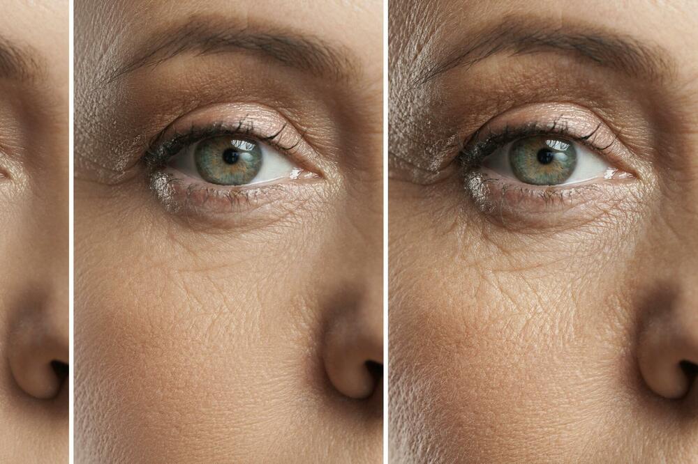 ŽELITE DA UKLONITE BORE? Bez operacije uz pomoć alpske ruže izgledajte mlađe i svežije!