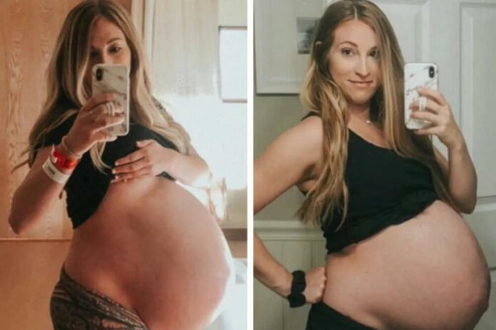 POSLE NIZA SPONTANIH POBAČAJA, NA ULTRAZVUKU JE VRISNULA, PA DOŽIVELA ŠOK: Šta joj se desilo sa STOMAKOM?! (FOTO)