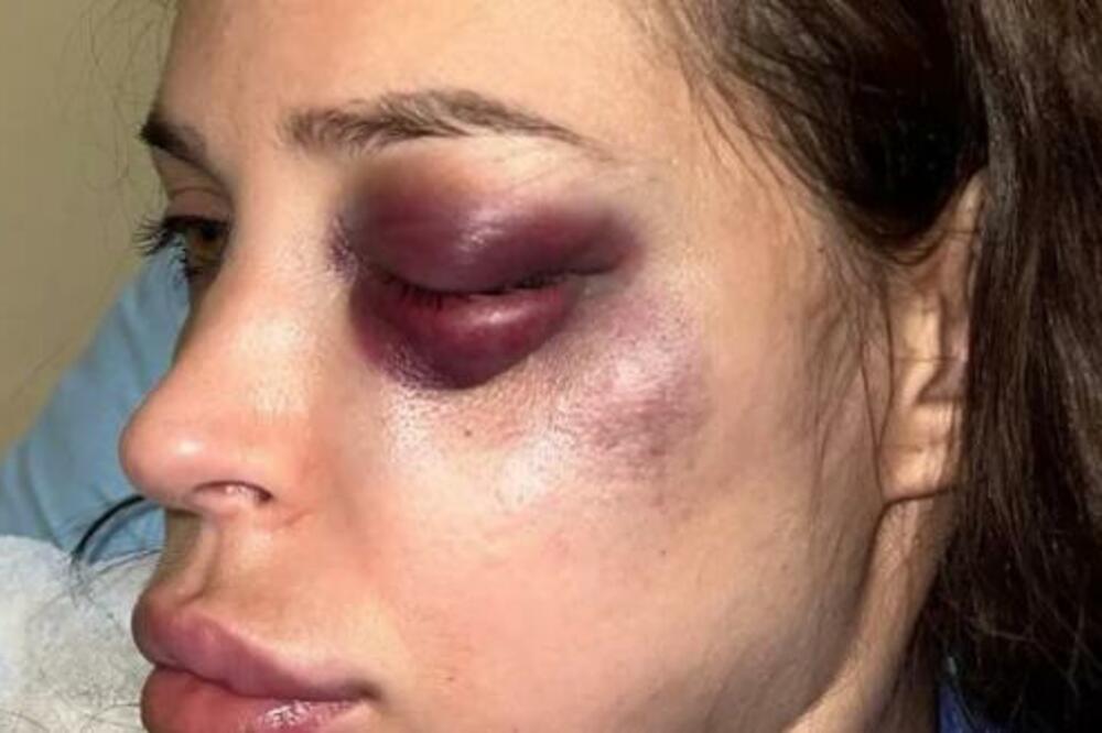 NATAŠI ŠAVIJI SE POGORŠALO STANJE