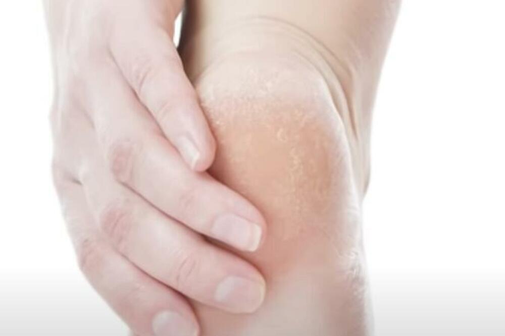 EVO KAKO DA REŠITE PROBLEM ISPUCALIH PETA: Ovaj PRIRODNI melem je spas za SUVU kožu na stpaima