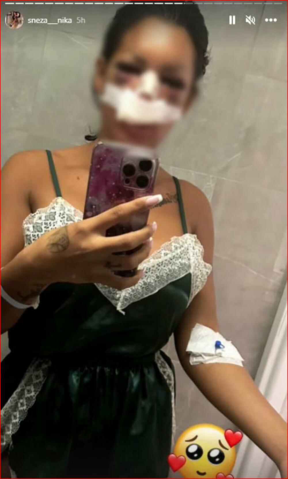 Bivša rijaliti učesnica u podlivima nakon operacije