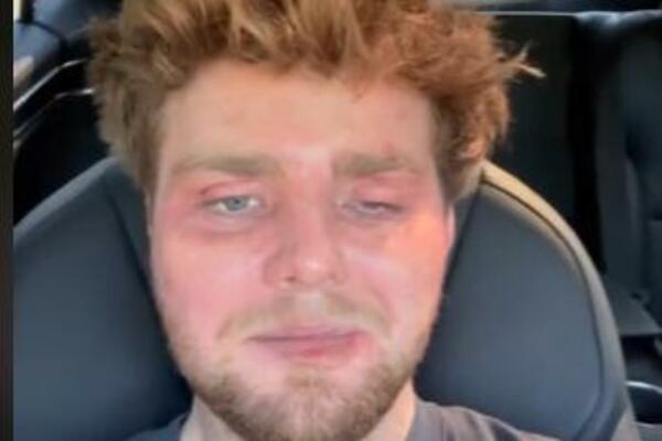 SLIKA IZDEFORMISANOG POZNATOG PEVAČA KRUŽI INTERNETOM: Jedno OKO mu zatvoreno, na drugo JEDVA GLEDA (VIDEO)