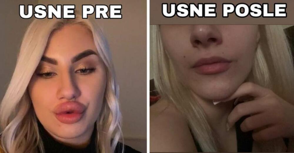 Pevačica ispumpala usne