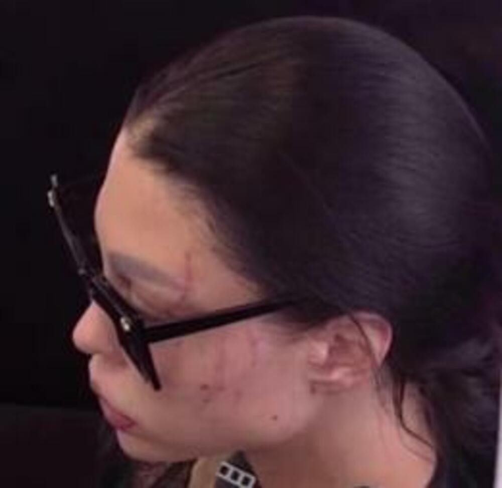 Maji Marinković unakaženo lice