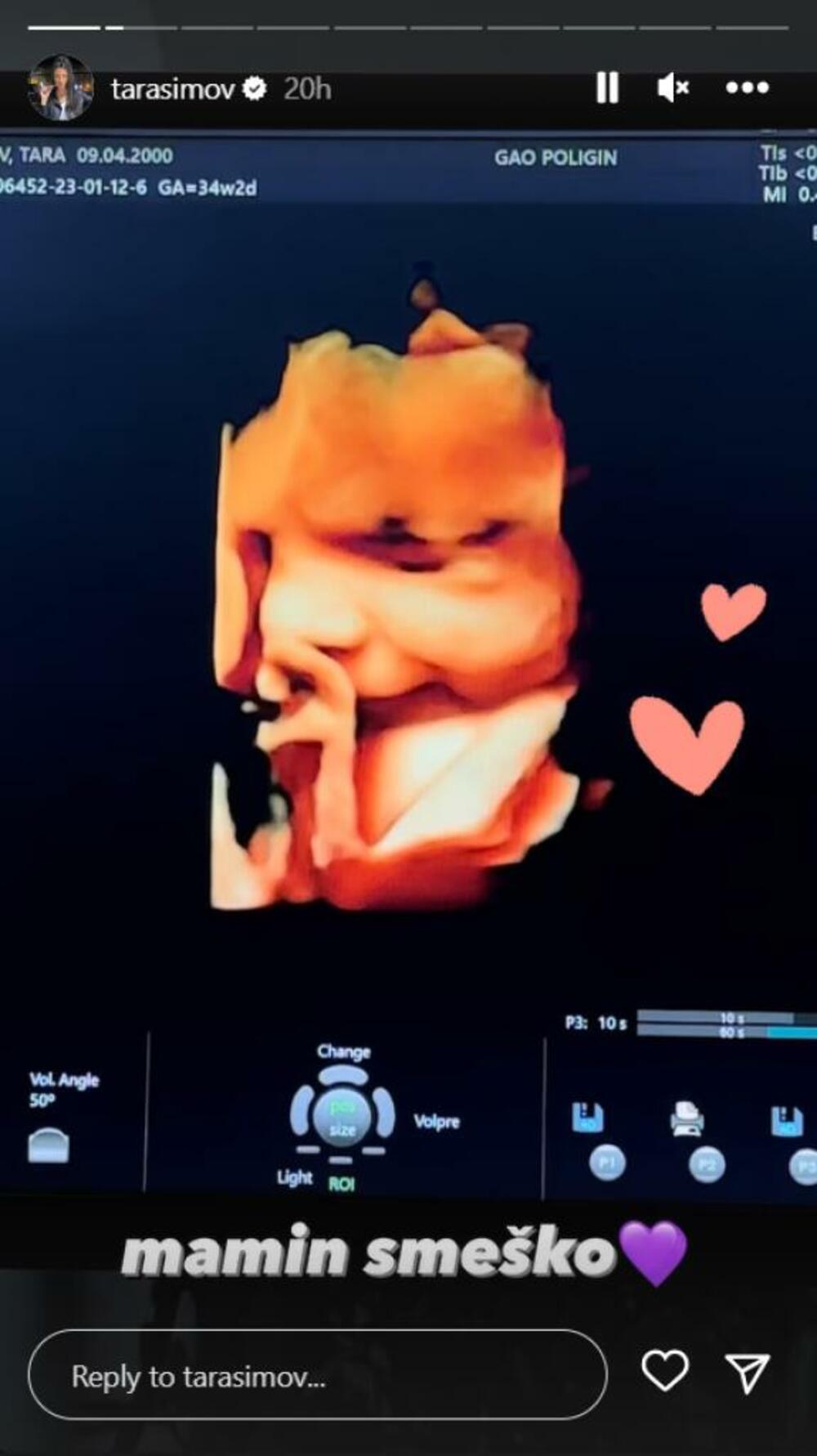 - Mamin smeško - napisala je Simova uz emotikone srca, a na fotografiji se jasno vidi nasmejano lice bebe.