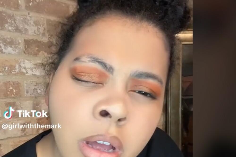 LEKARI SE IZBEZUMILI KAD SU JE VIDELI, UPLAŠILI SE DA JE DOTAKNU: Kad VIDITE šta je IMALA na licu ZANEMEĆETE! VIDEO