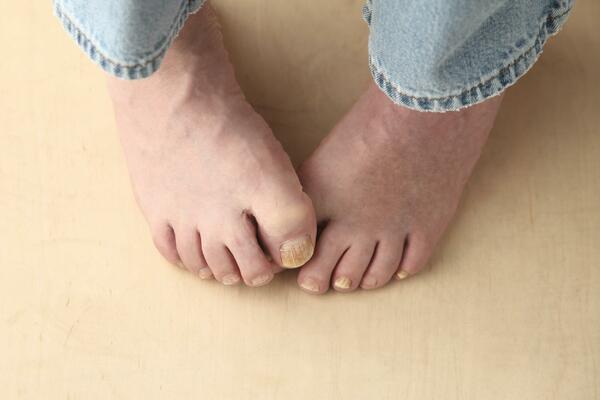 KAKO DA SE REŠITE GLJIVICA: Ne skrivajte vaša stopala, mogu da budu lepa i zdrava ovog leta - evo kako!