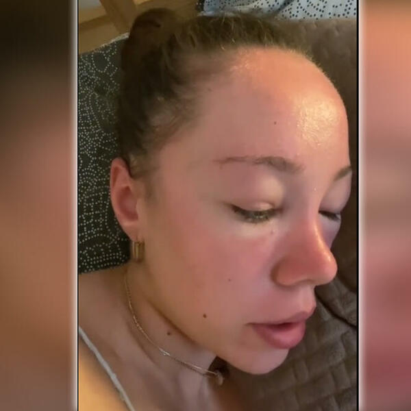 SUNČALA SE SA FAKTOROM, ALI JOJ SE LICE IZDEFORMISALO: Evo i zašto je završila sa STRAŠNIM posledicama (VIDEO)