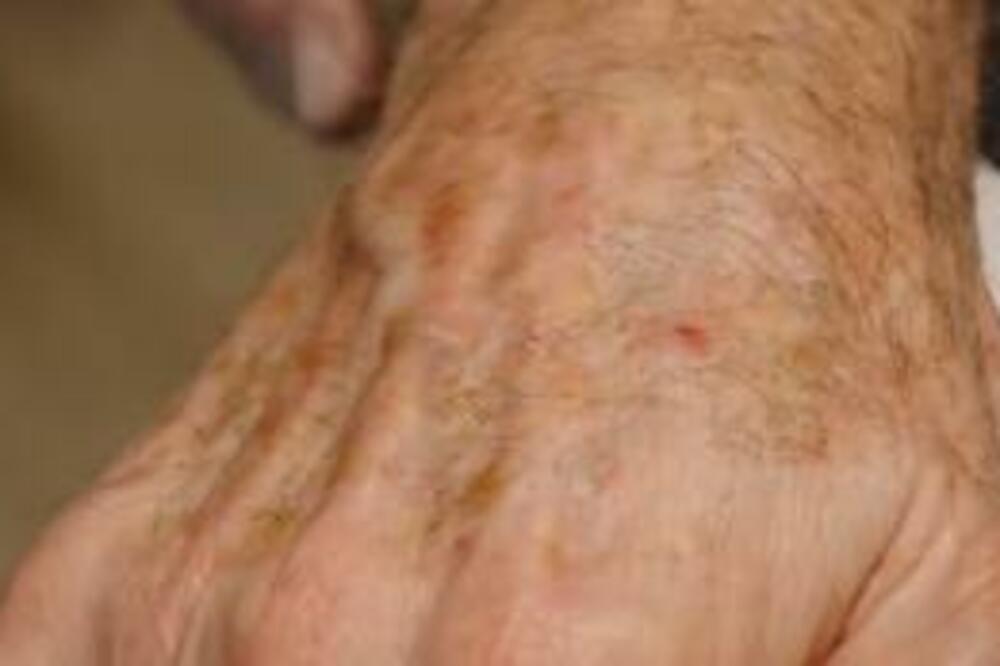 STRUČNJAK OTKRIO KAKO DA UKLONITE STARAČKE PEGE: Ne treba vam LASER, ovo možete i sami KOD KUĆE