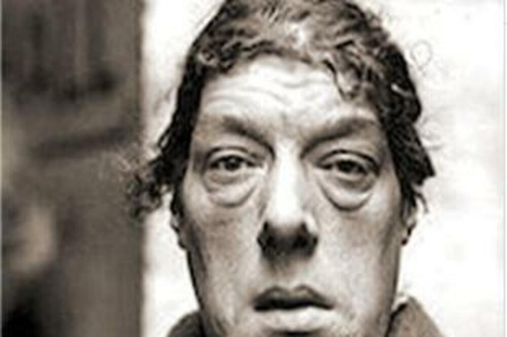 BILA JE PRAVA LEPOTICA, ONDA SU JE PROGLASILI NAJRUŽNIJOM NA SVETU: Evo koji ZDRAVSTVENI PROBLEM se krio IZA SVEGA