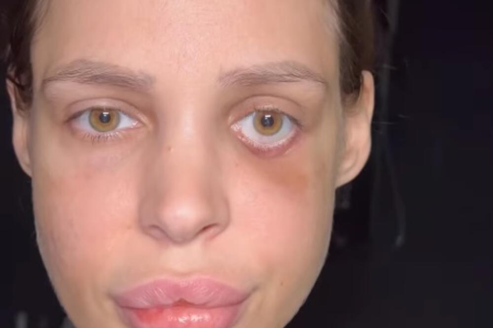 NATAŠA ŠAVIJA PONOVO MORALA NA OPERACIJU: Ima li kraja agoniji?