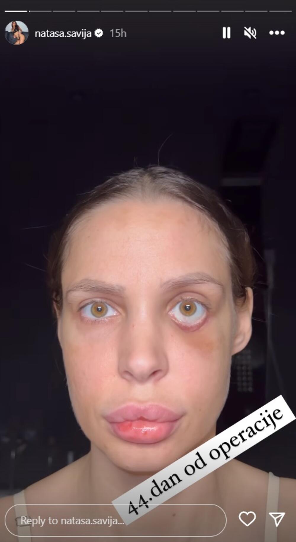 Šavija je 30. aprila je Nataša optužila je Karića da ju je udario pesnicom u lice i tom prilikom slomio jagodičnu kost.