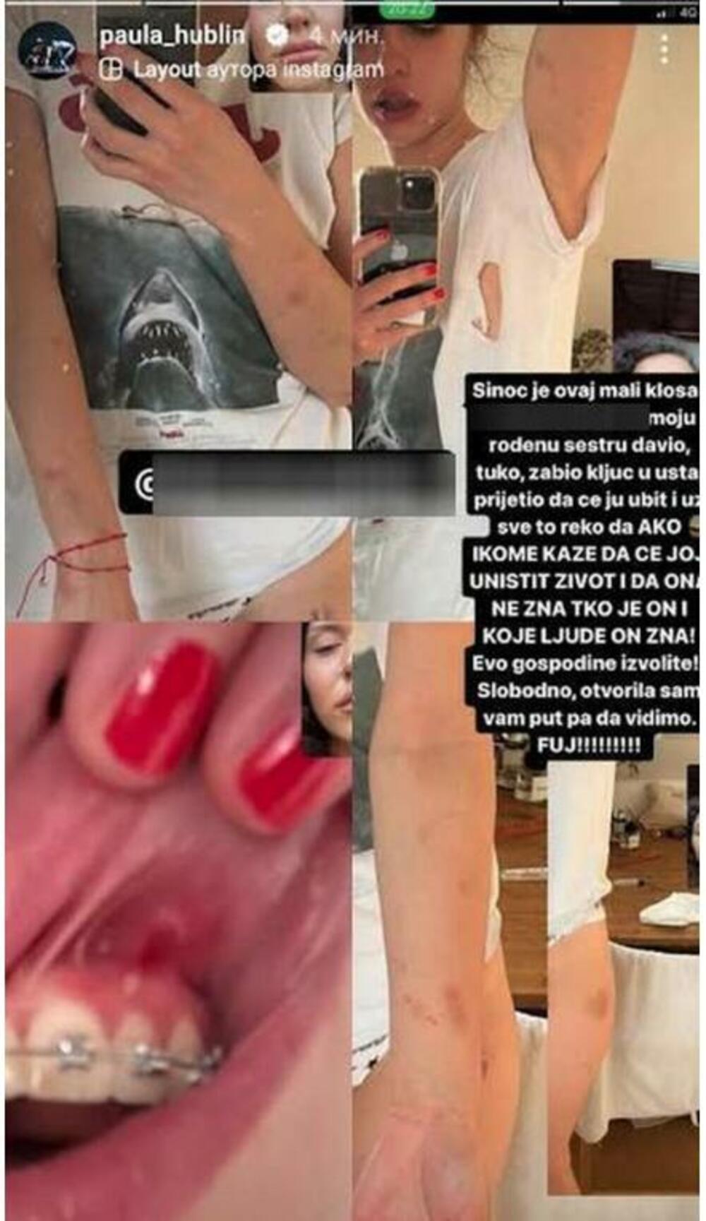 Ona je uslikala modrice, pocepanu majicu, ogrebotine, kao i razbijene usne