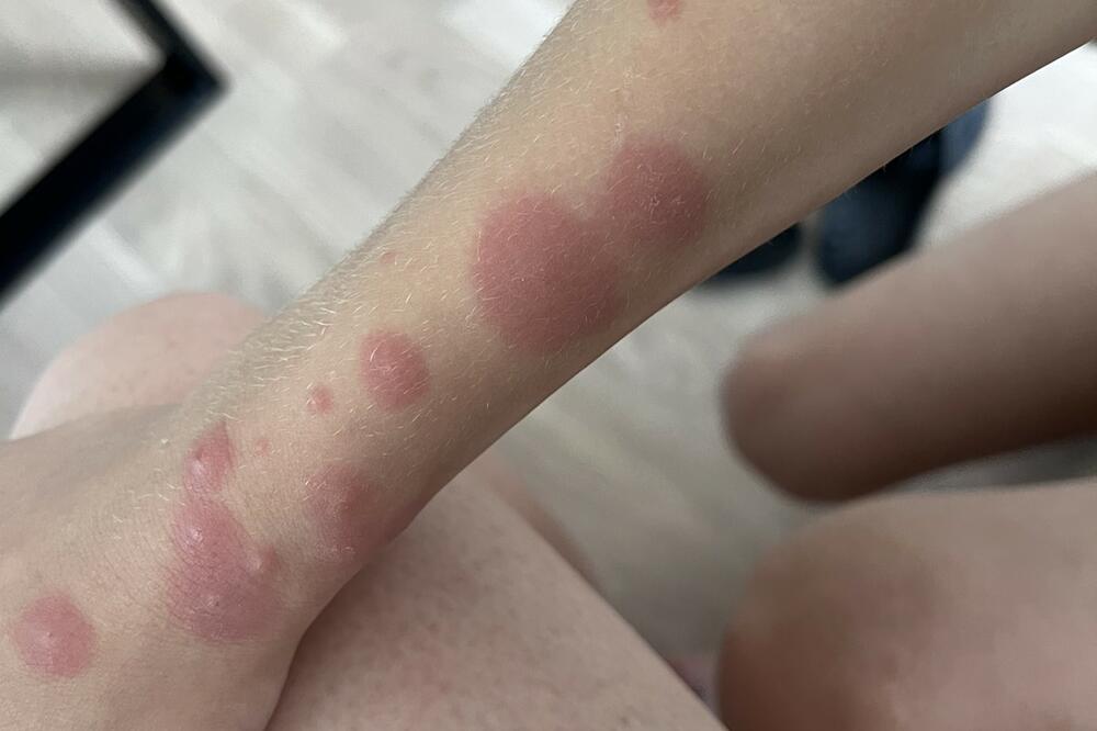 UJED STENICE MOŽE DA IZAZOVE OPAKE PROBLEME SA KOŽOM: Ovo su PRVI SIMPTOMI, a uz 1 CAKU rešićete ih se ZAUVEK