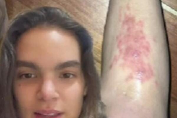 UŽIVALA JE NA MORU, A ONDA JE POČEO PRAVI PAKAO: Mislila je da ima ALERGIJU, dok nije primetila OVO! (VIDEO)