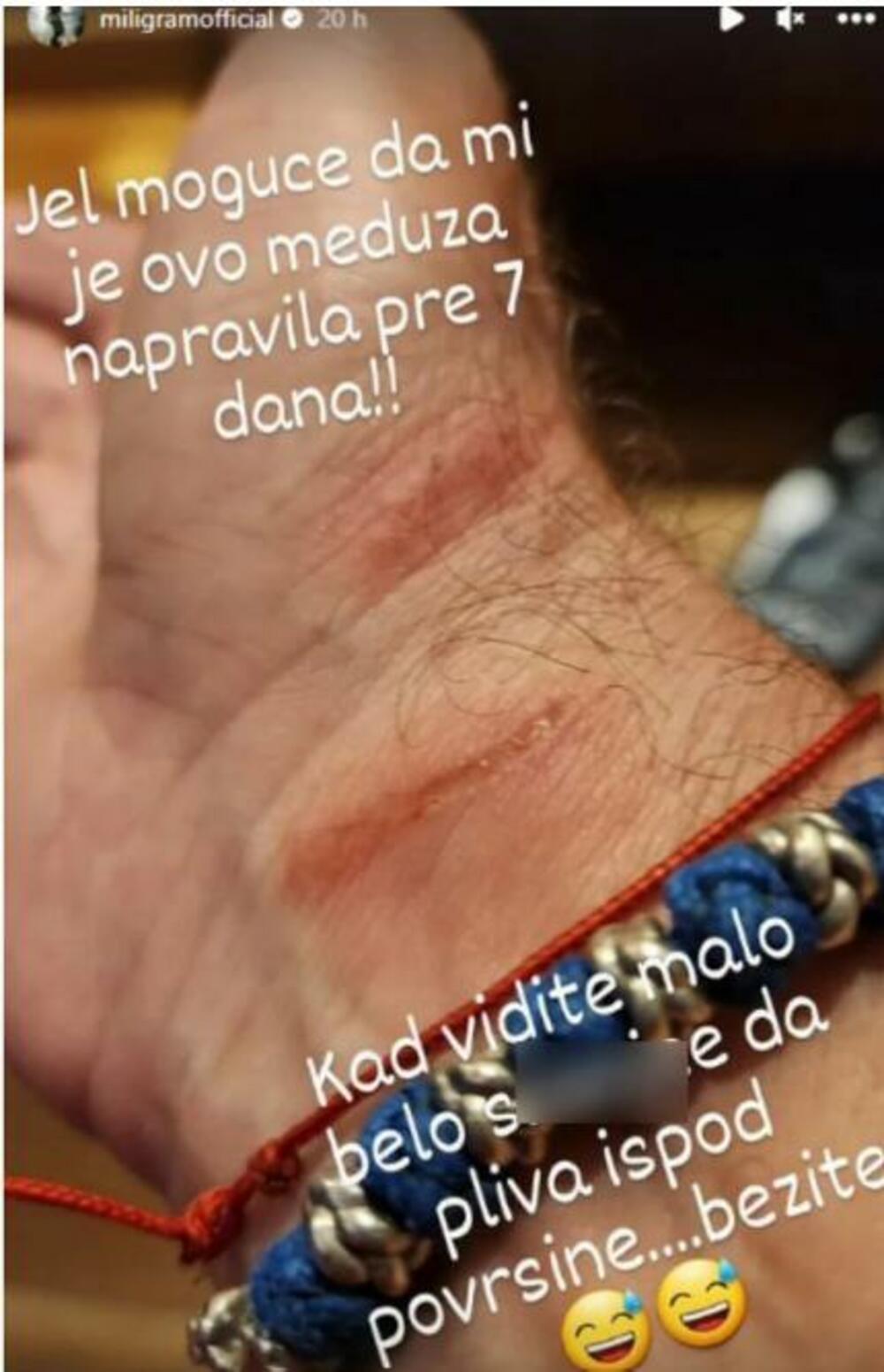 Rane na ruci Aleksandra Milića Milija