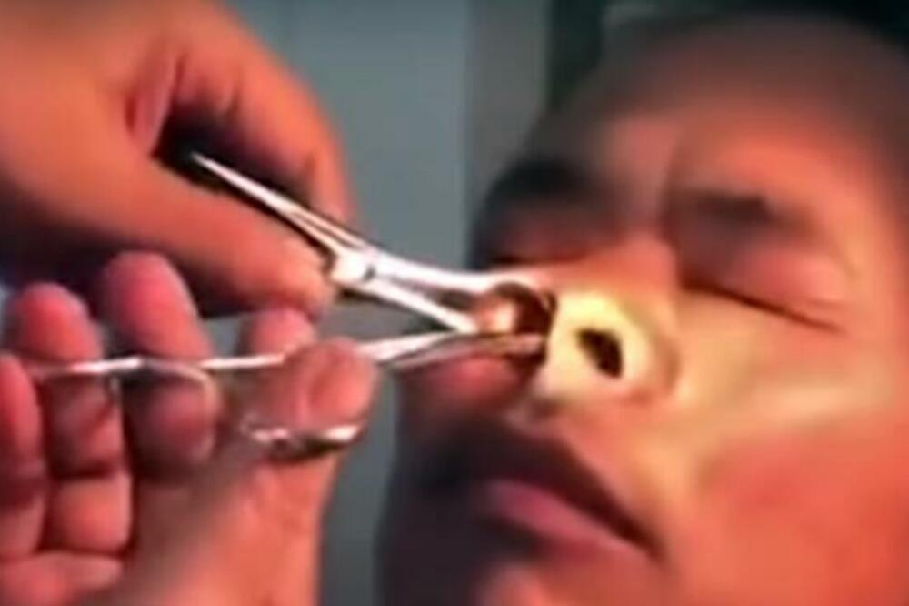 ŽENA PRIMETILA DA MU SE NEŠTO MRDA U NOZDRVI: Kada su LEKARI videli šta mu je ŽIVELO U NOSU ostali u čudu!