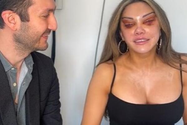 ŽELELA JE MAČJE OČI, A ONDA JE SVE KRENULO NAOPAKO: Sada jedva može da gleda, izgleda ZASTRAŠUJUĆE (VIDEO)