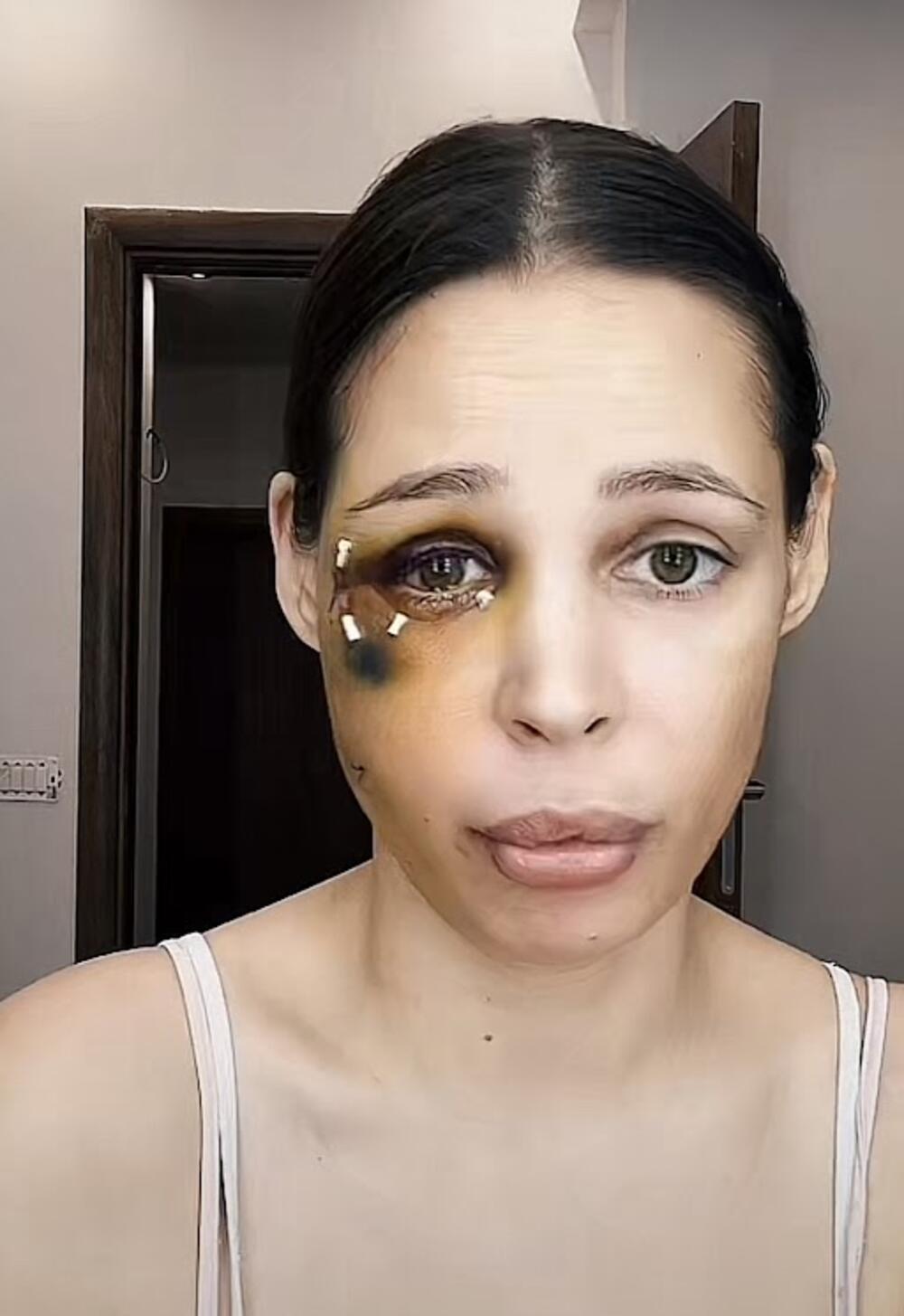 Starleta pokazala podliv ispod oka