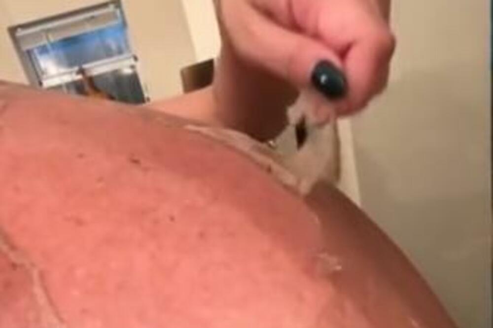 SRPSKI HIRURG OTKRIO ZAŠTO NIKAD NE SMETE DA OLJUŠTITE KOŽU: Evo kakav vas HOROR čeka, NE RADITE TO
