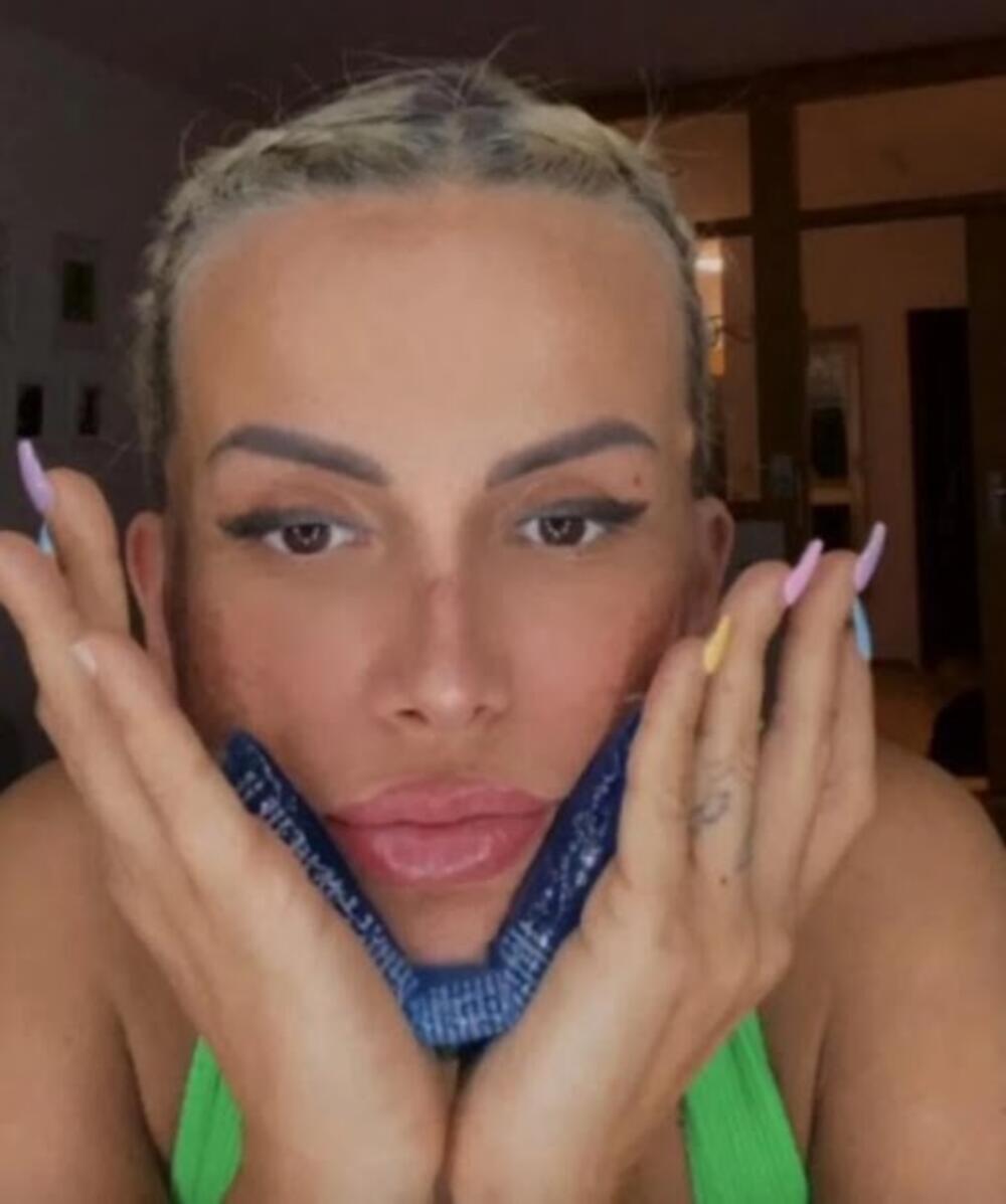 Ermina se operisala i skinula zavoje