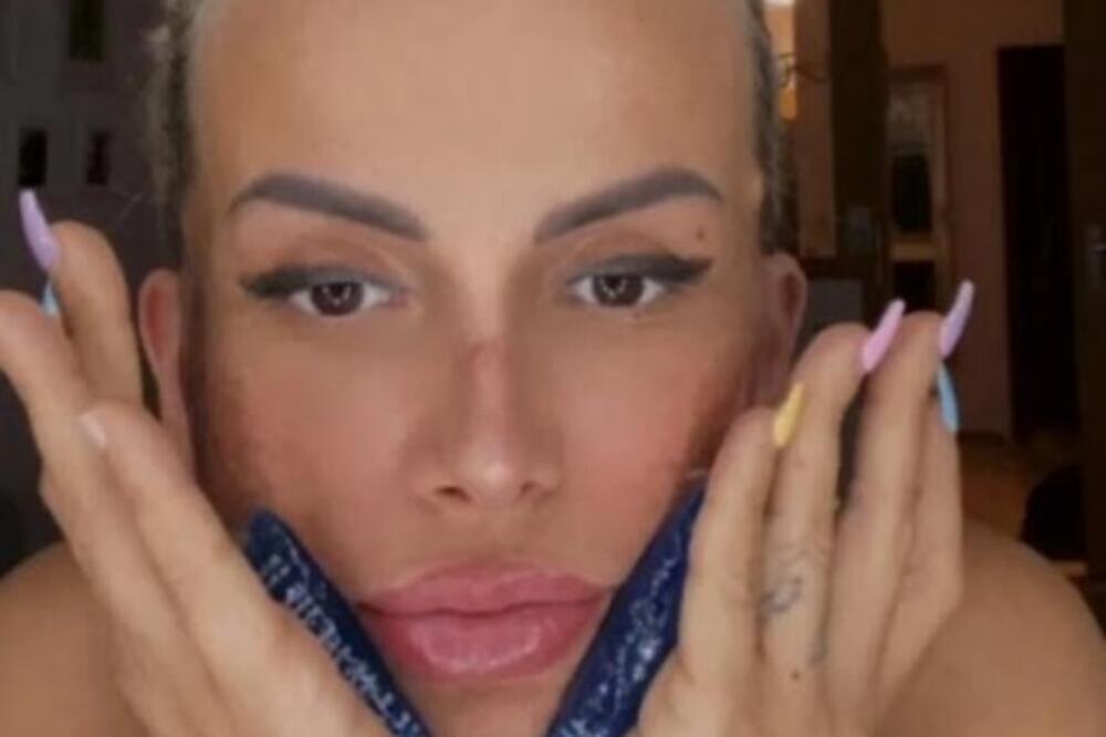 TVRDI DA JE JOŠ UVEK DEFORMISANA: Sva u OTOCIMA i PODLIVIMA, Erminina FOTOGRAFIJA nakon operacije izazvala PAŽNJU