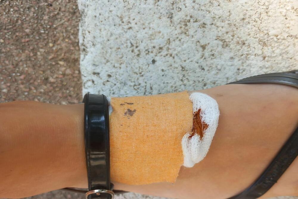 SLAVICA ŠETALA PA OSETILA DA JE NEŠTO UJELO ZA NOGU: Videla ga je KAKO BEŽI, odmah je OTIŠLA u HITNU (FOTO)