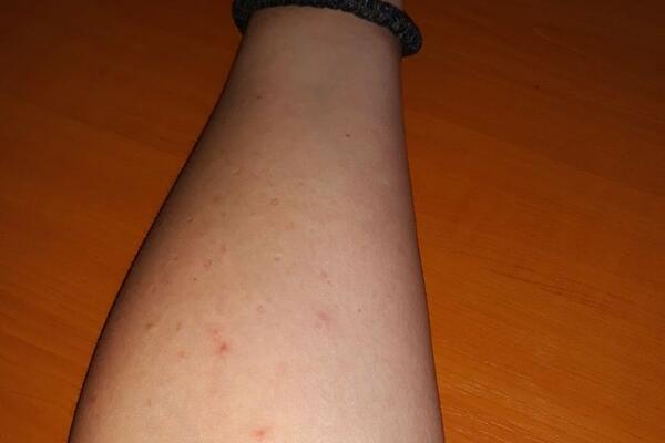 ANDRIJANA SAMA IZVADILA 20 KRPELJA, A ZA OSTALE MORALA DA IDE KOD LEKARA: Berba ove voćke se pretvorila u AGONIJU!