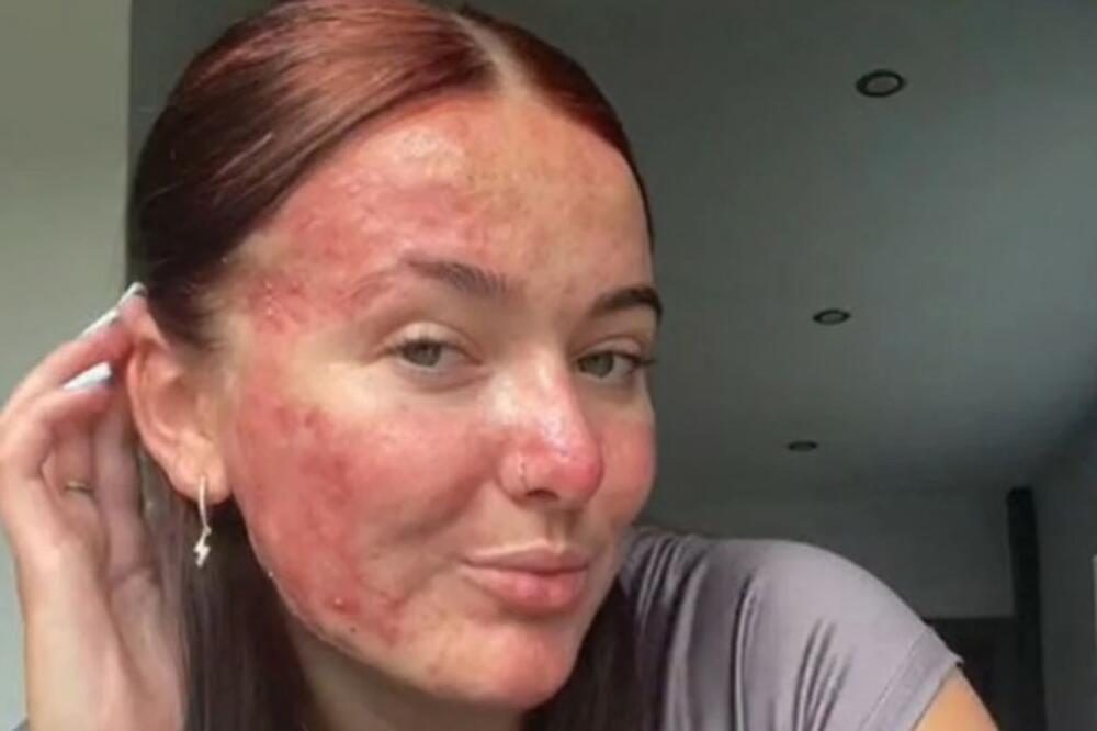 GODINAMA JE IMALA AKNE, DRUGARI SU JOJ SE RUGALI I SVI SU JE IZBEGAVALI: Gledajte samo kako DANAS IZGLEDA... (FOTO)