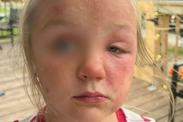 OVA BILJKA RASTE U CELOJ SRBIJI I EKSTREMNO JE OTROVNA: Devojčica sa SLIKE je JEDVA PREŽIVELA kad je.. UZNEMIRUJUĆE