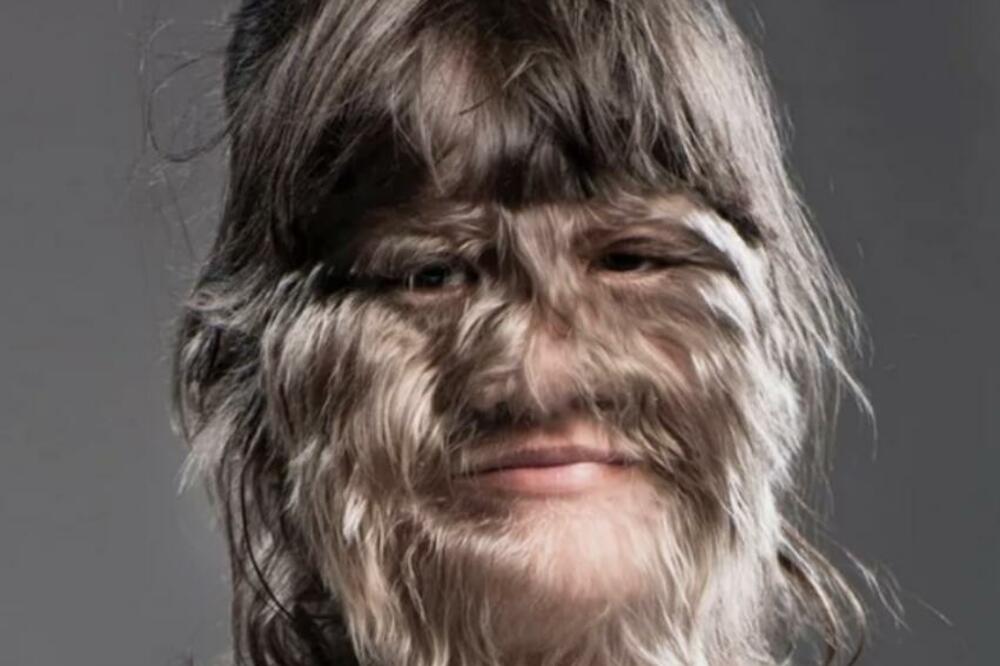 BILA JE NAJDLAKAVIJA DEVOJČICA NA SVETU ZVALI SU JE VUKODLAKOM: Usledila je TRANSFORMACIJA ŽIVOTA SAD IZGLEDA OVAKO