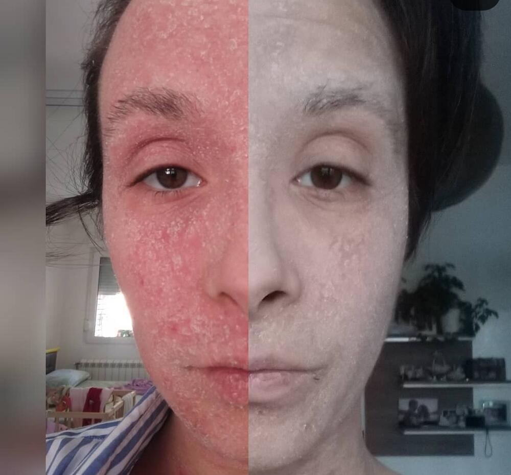 Faza crvenila i faza perutanja tok koje koža pobeli