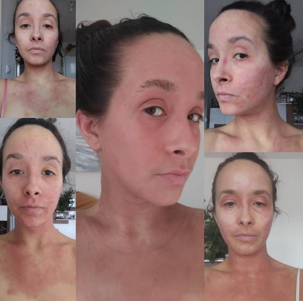 Početna faza u kojoj crvenilo bukvalno šeta po Anđelinom telu