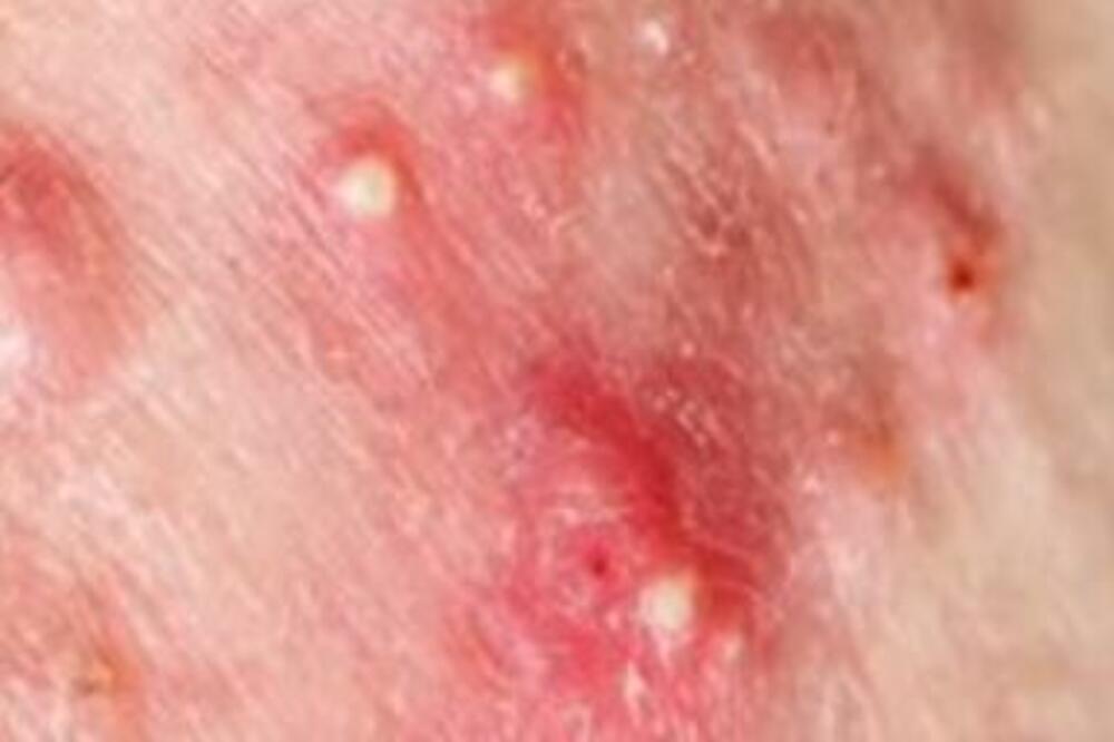 NEMA NIŠTA GADNIJE OD AKNI NA ZADNJICI: Doktor OTKRIO kako da ih se rešite JEDNOM ZAUVEK